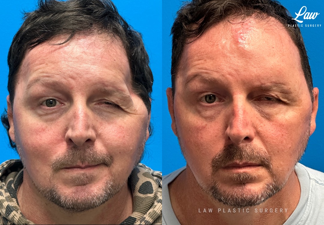 Craniofacial Reconstruction Before & After Photo. Surgery performed in Dallas, TX at Law Plastic Surgery.