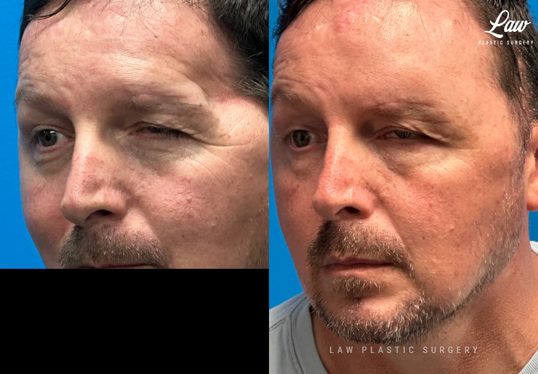 Craniofacial Reconstruction Before & After Photo. Surgery performed in Dallas, TX at Law Plastic Surgery.