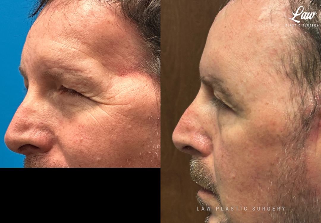 Craniofacial Reconstruction Before & After Photo. Surgery performed in Dallas, TX at Law Plastic Surgery.