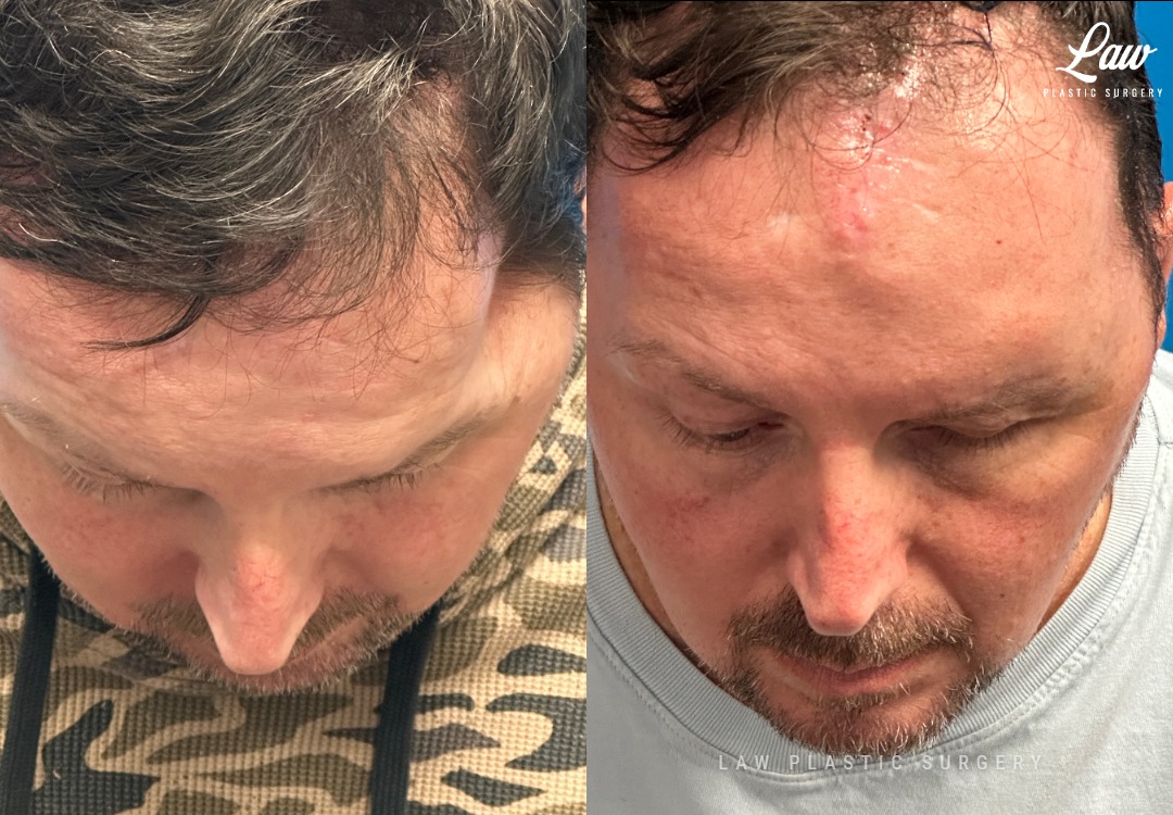 Craniofacial Reconstruction Before & After Photo. Surgery performed in Dallas, TX at Law Plastic Surgery.