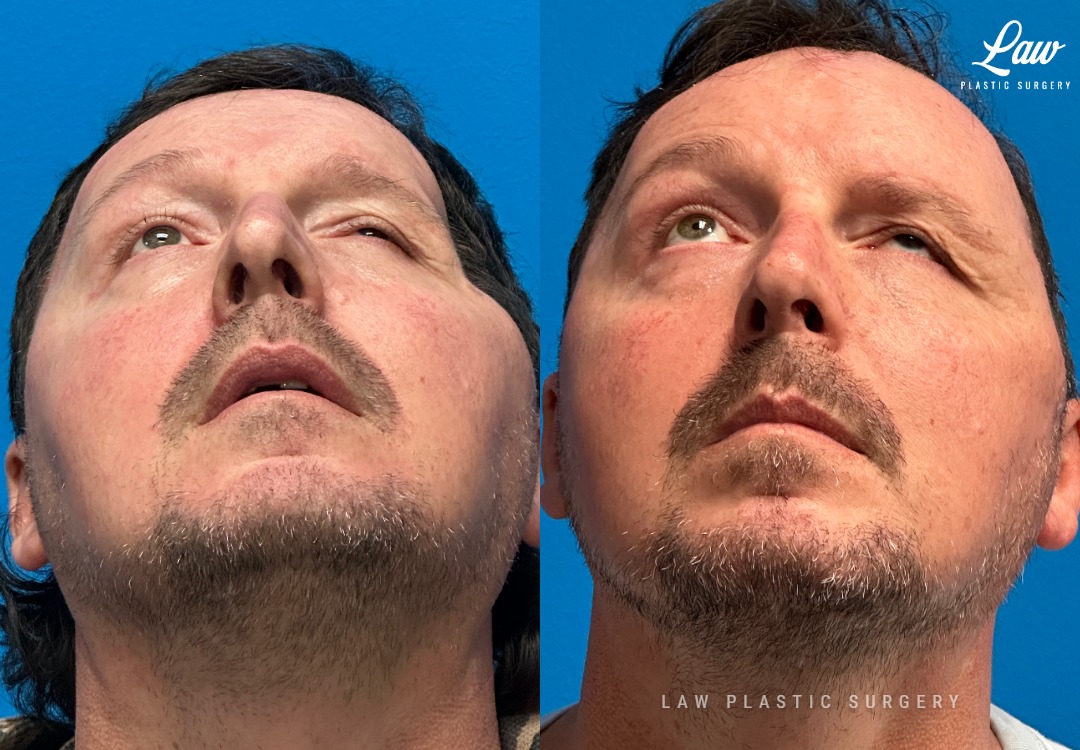 Craniofacial Reconstruction Before & After Photo. Surgery performed in Dallas, TX at Law Plastic Surgery.