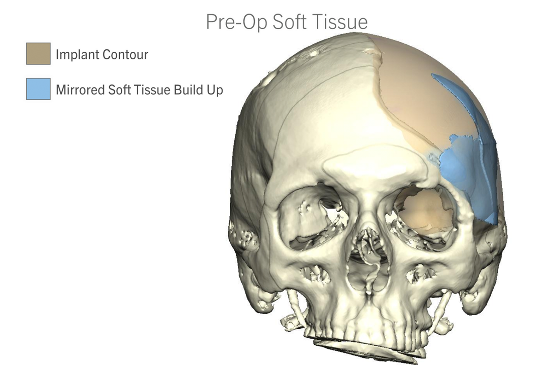 Craniofacial Reconstruction Before & After Photo. Surgery performed in Dallas, TX at Law Plastic Surgery.
