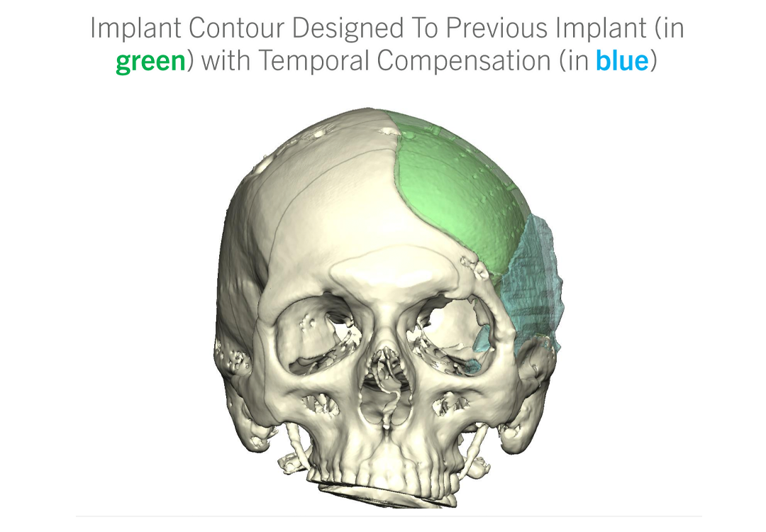 Craniofacial Reconstruction Before & After Photo. Surgery performed in Dallas, TX at Law Plastic Surgery.