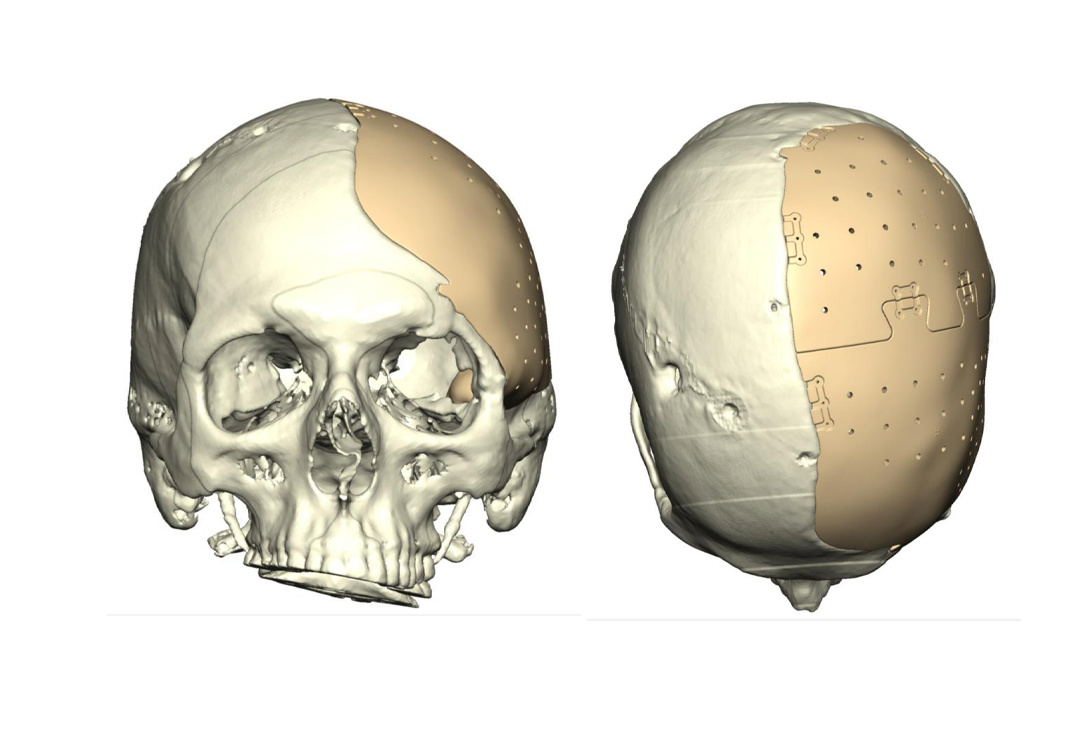 Craniofacial Reconstruction Before & After Photo. Surgery performed in Dallas, TX at Law Plastic Surgery.