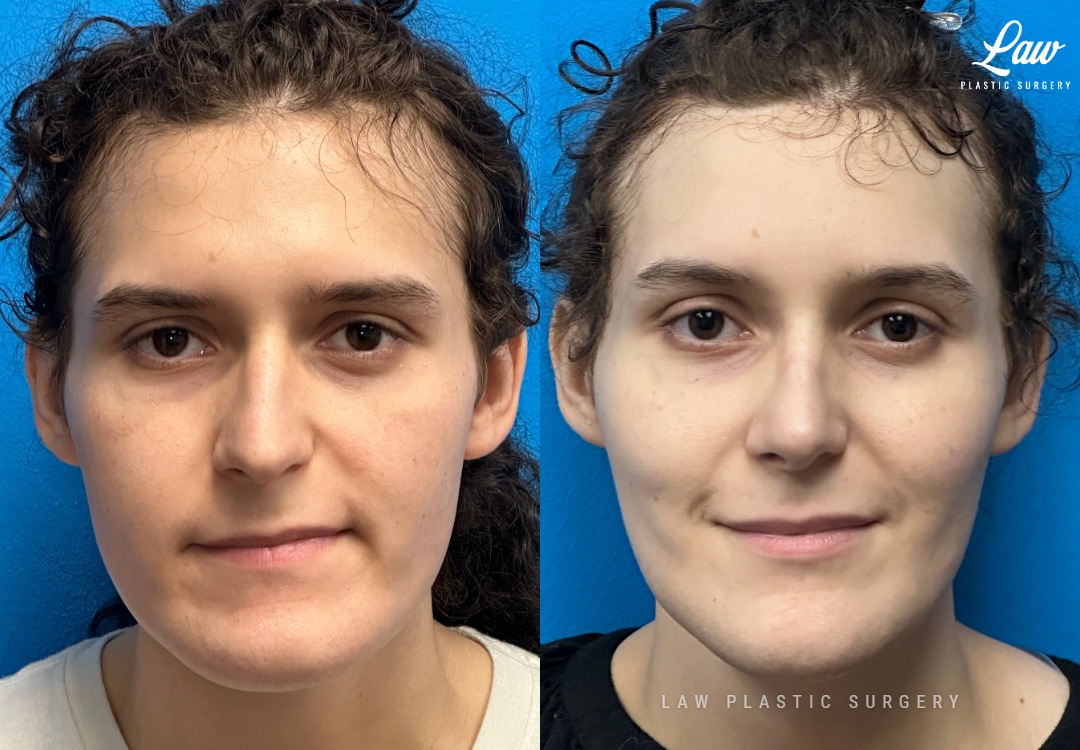 Facial Feminization Before & After Photo. Surgery performed in Dallas, TX at Law Plastic Surgery.