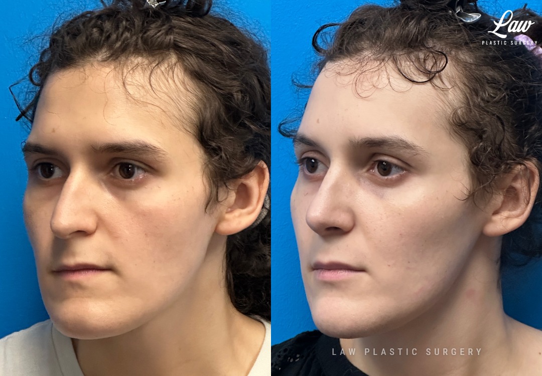 Facial Feminization Before & After Photo. Surgery performed in Dallas, TX at Law Plastic Surgery.