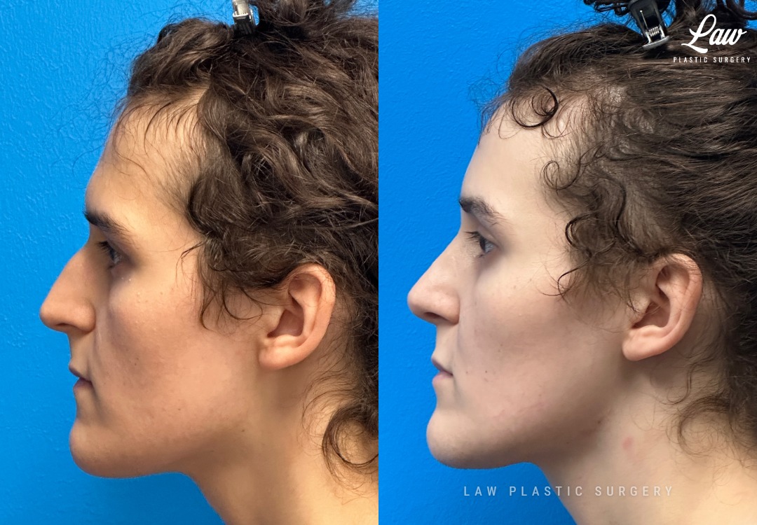 Facial Feminization Before & After Photo. Surgery performed in Dallas, TX at Law Plastic Surgery.