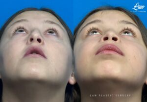 Jaw Surgery Before and After Photo. Surgery performed in Dallas, TX at Law Plastic Surgery.