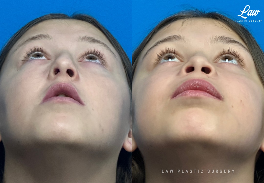 Jaw Surgery Before and After Photo. Surgery performed in Dallas, TX at Law Plastic Surgery.