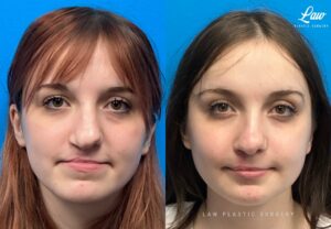 Jaw Surgery Before and After Photo. Surgery performed in Dallas, TX at Law Plastic Surgery.
