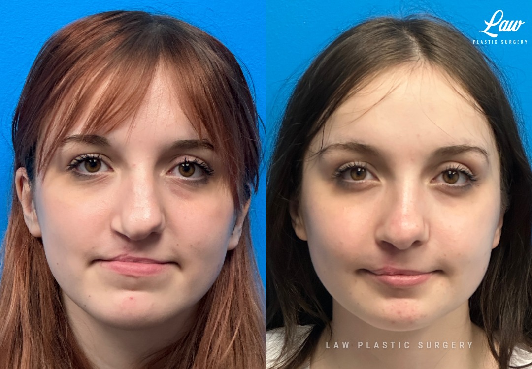 Jaw Surgery Before and After Photo. Surgery performed in Dallas, TX at Law Plastic Surgery.