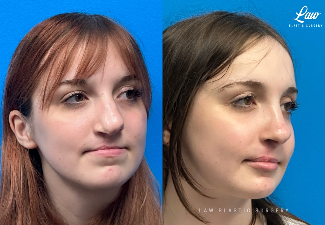 Jaw Surgery Before and After Photo. Surgery performed in Dallas, TX at Law Plastic Surgery.