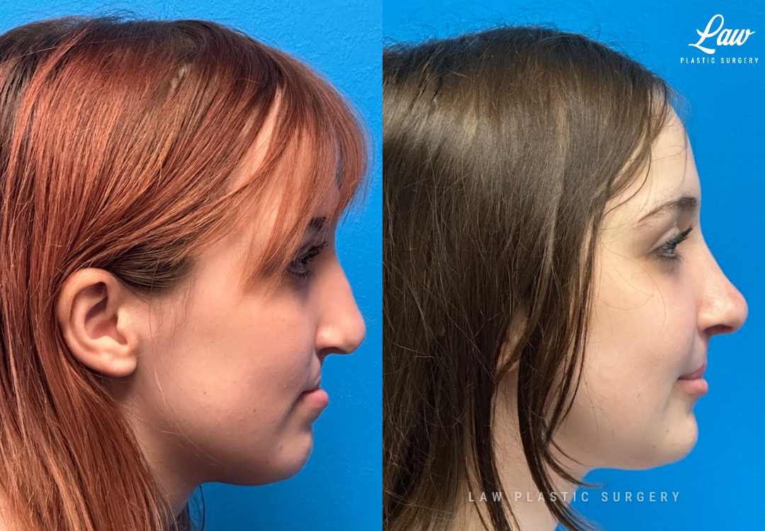 Jaw Surgery Before and After Photo. Surgery performed in Dallas, TX at Law Plastic Surgery.