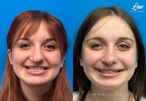 Jaw Surgery Before and After Photo. Surgery performed in Dallas, TX at Law Plastic Surgery.