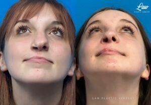 Jaw Surgery Before and After Photo. Surgery performed in Dallas, TX at Law Plastic Surgery.
