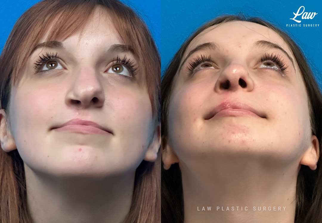 Jaw Surgery Before and After Photo. Surgery performed in Dallas, TX at Law Plastic Surgery.
