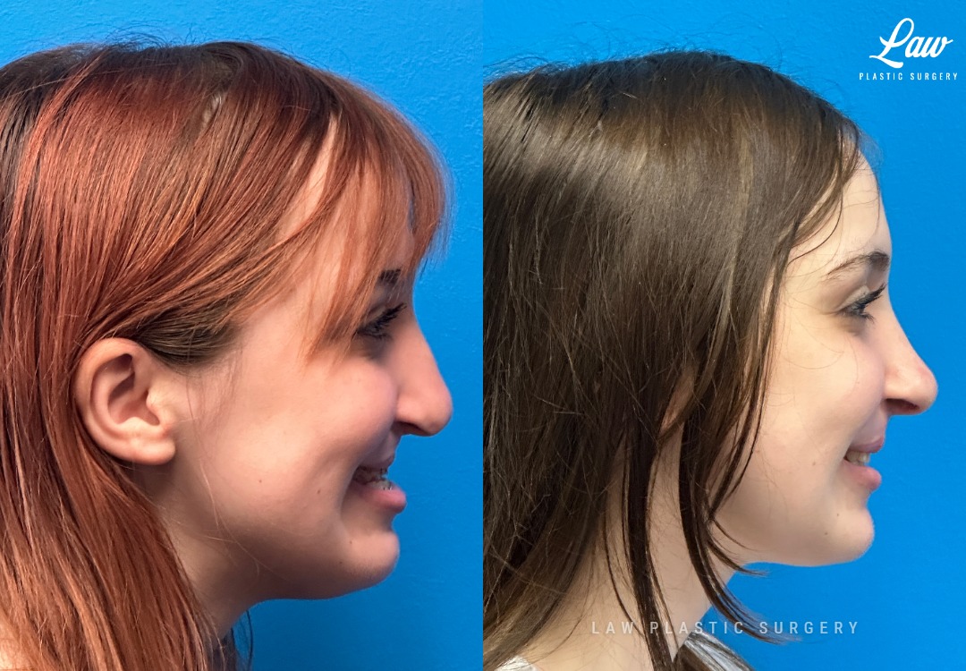 Jaw Surgery Before and After Photo. Surgery performed in Dallas, TX at Law Plastic Surgery.