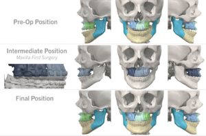 Jaw Surgery Before and After Photo. Surgery performed in Dallas, TX at Law Plastic Surgery.