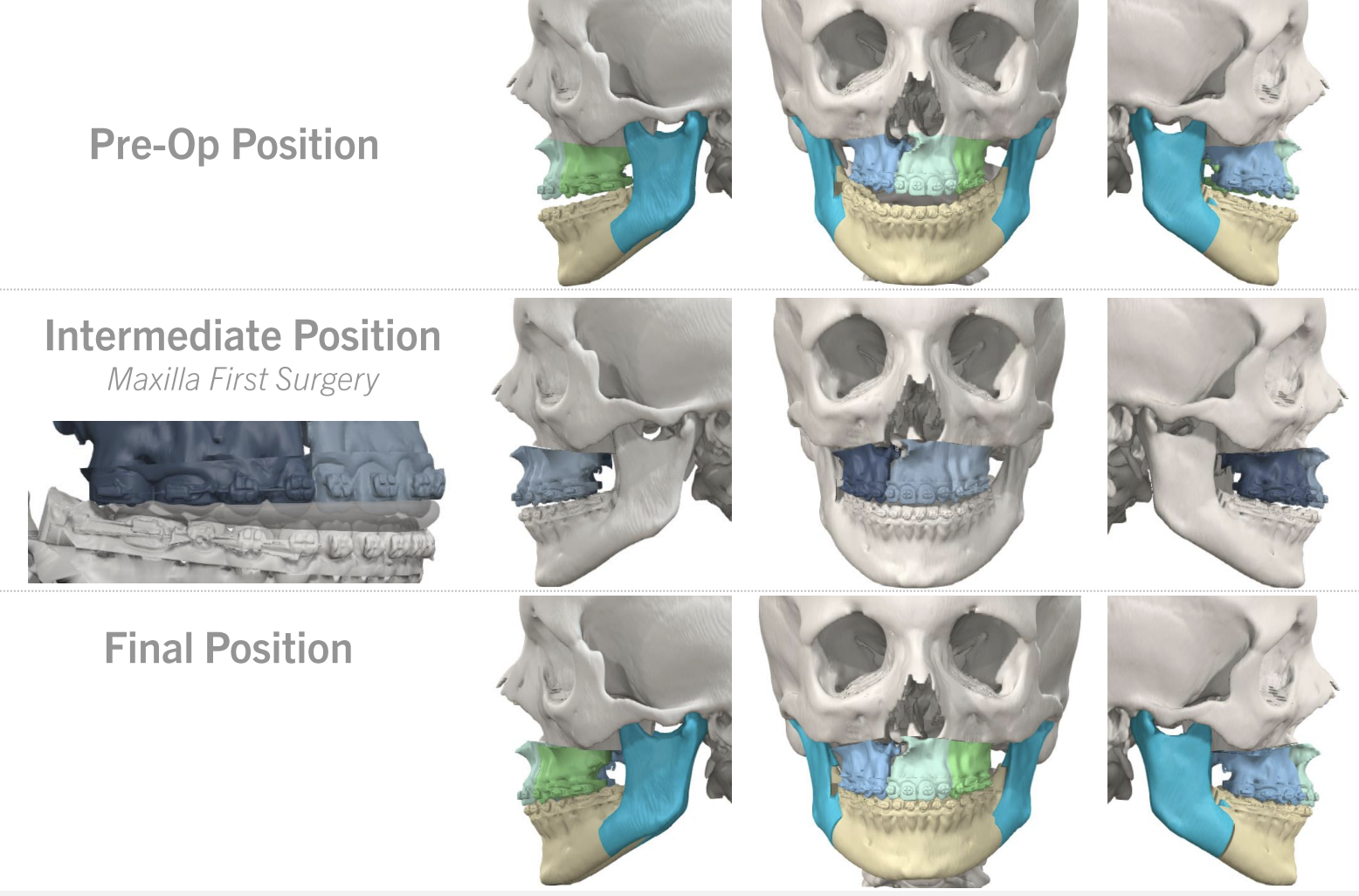 Jaw Surgery Before and After Photo. Surgery performed in Dallas, TX at Law Plastic Surgery.
