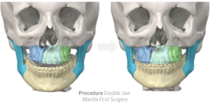 Jaw Surgery Before and After Photo. Surgery performed in Dallas, TX at Law Plastic Surgery.
