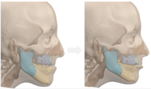 Jaw Surgery Before and After Photo. Surgery performed in Dallas, TX at Law Plastic Surgery.
