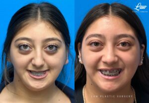 Jaw Surgery Before and After Photo. Surgery performed in Dallas, TX at Law Plastic Surgery.