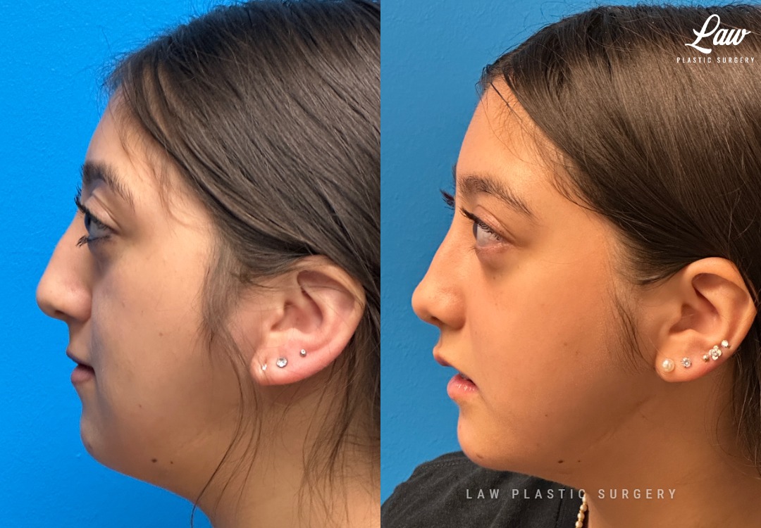 Jaw Surgery Before and After Photo. Surgery performed in Dallas, TX at Law Plastic Surgery.