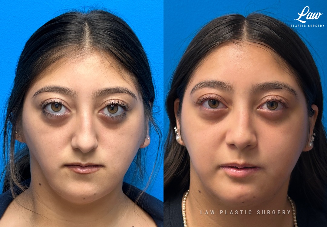Jaw Surgery Before and After Photo. Surgery performed in Dallas, TX at Law Plastic Surgery.