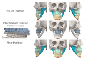 Jaw Surgery Before and After Photo. Surgery performed in Dallas, TX at Law Plastic Surgery.