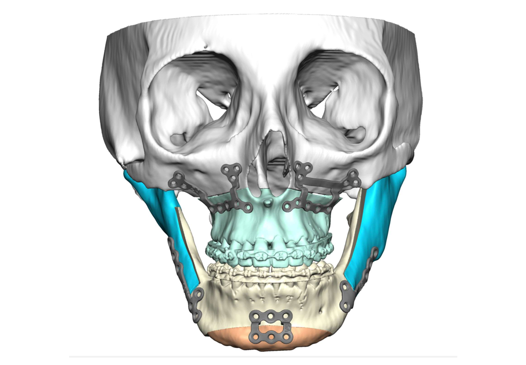 Jaw Surgery Before and After Photo. Surgery performed in Dallas, TX at Law Plastic Surgery.