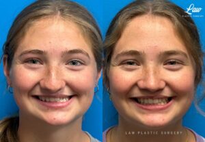 Jaw Surgery Before and After Photo. Surgery performed in Dallas, TX at Law Plastic Surgery.