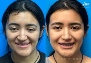 Jaw Surgery Before and After Photo. Surgery performed in Dallas, TX at Law Plastic Surgery.