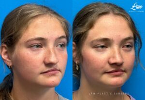 Jaw Surgery Before and After Photo. Surgery performed in Dallas, TX at Law Plastic Surgery.
