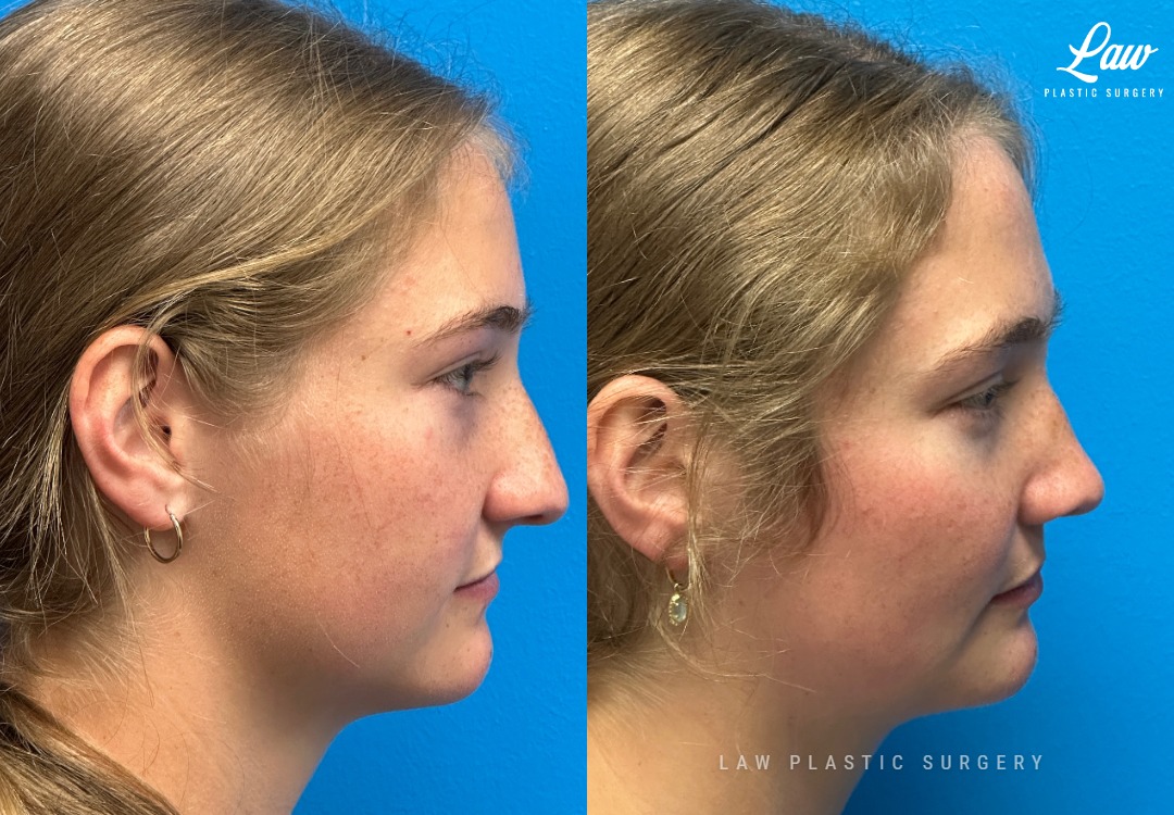 Jaw Surgery Before and After Photo. Surgery performed in Dallas, TX at Law Plastic Surgery.