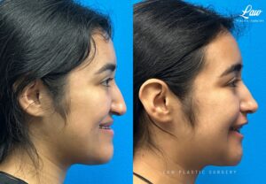 Jaw Surgery Before and After Photo. Surgery performed in Dallas, TX at Law Plastic Surgery.