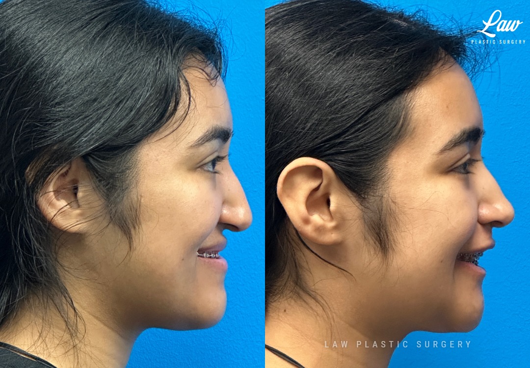 Jaw Surgery Before and After Photo. Surgery performed in Dallas, TX at Law Plastic Surgery.