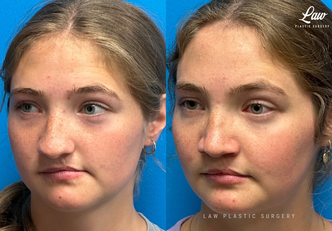 Jaw Surgery Before and After Photo. Surgery performed in Dallas, TX at Law Plastic Surgery.