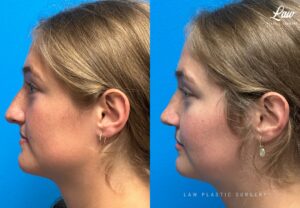 Jaw Surgery Before and After Photo. Surgery performed in Dallas, TX at Law Plastic Surgery.