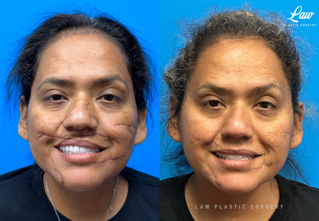 Scar Revision Before and After Photo. Surgery performed in Dallas, TX at Law Plastic Surgery.