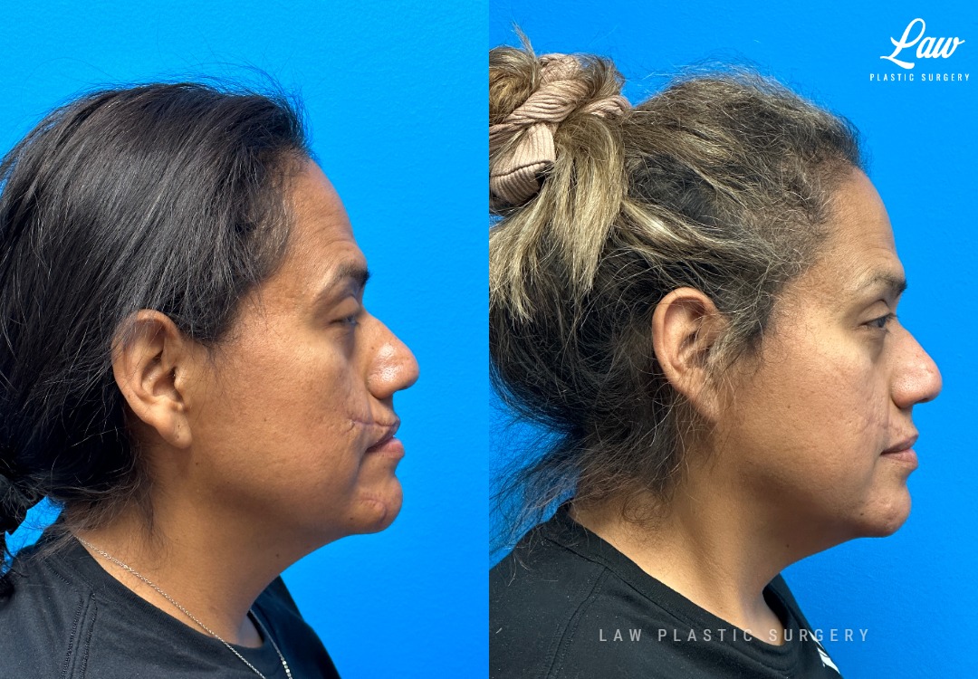 Scar Revision Before and After Photo. Surgery performed in Dallas, TX at Law Plastic Surgery.