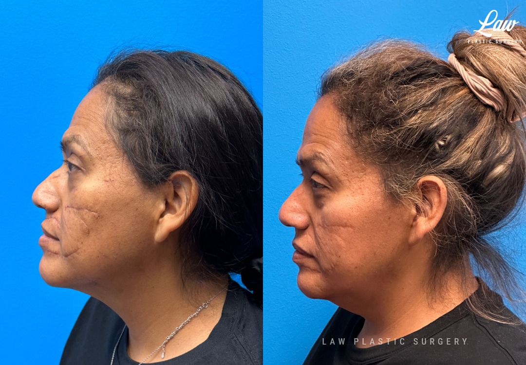 Scar Revision Before and After Photo. Surgery performed in Dallas, TX at Law Plastic Surgery.