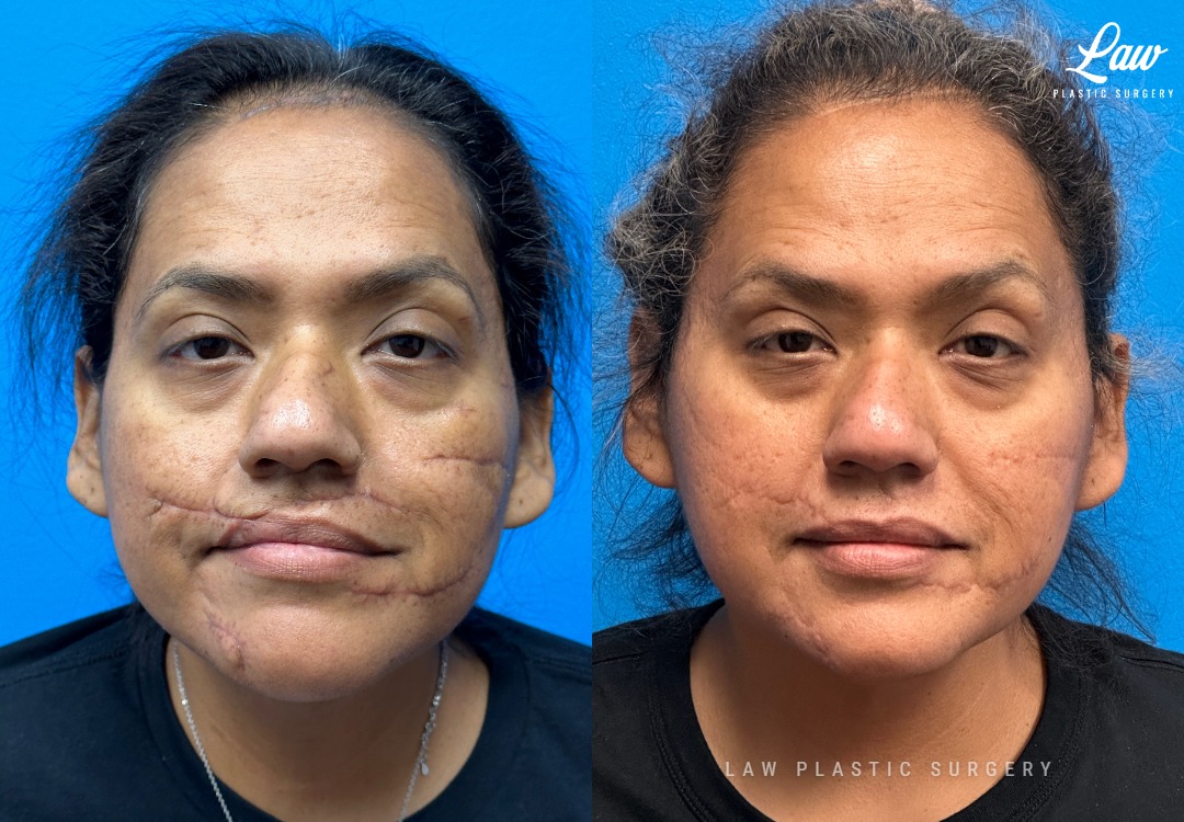 Scar Revision Before and After Photo. Surgery performed in Dallas, TX at Law Plastic Surgery.