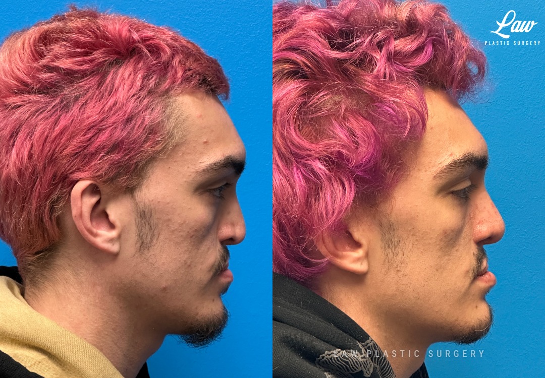 Septoplasty Before & After Photo. Surgery performed in Dallas, TX at Law Plastic Surgery.