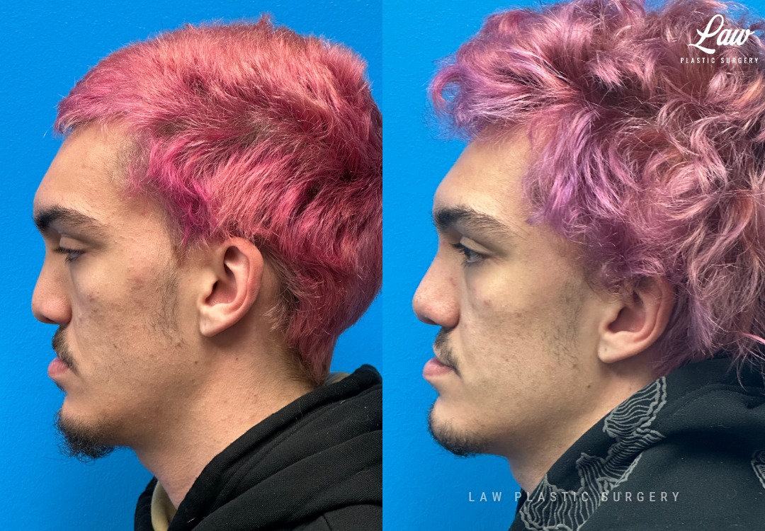 Septoplasty Before & After Photo. Surgery performed in Dallas, TX at Law Plastic Surgery.