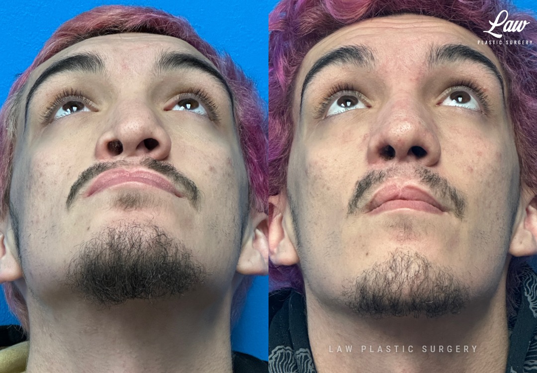 Septoplasty Before & After Photo. Surgery performed in Dallas, TX at Law Plastic Surgery.